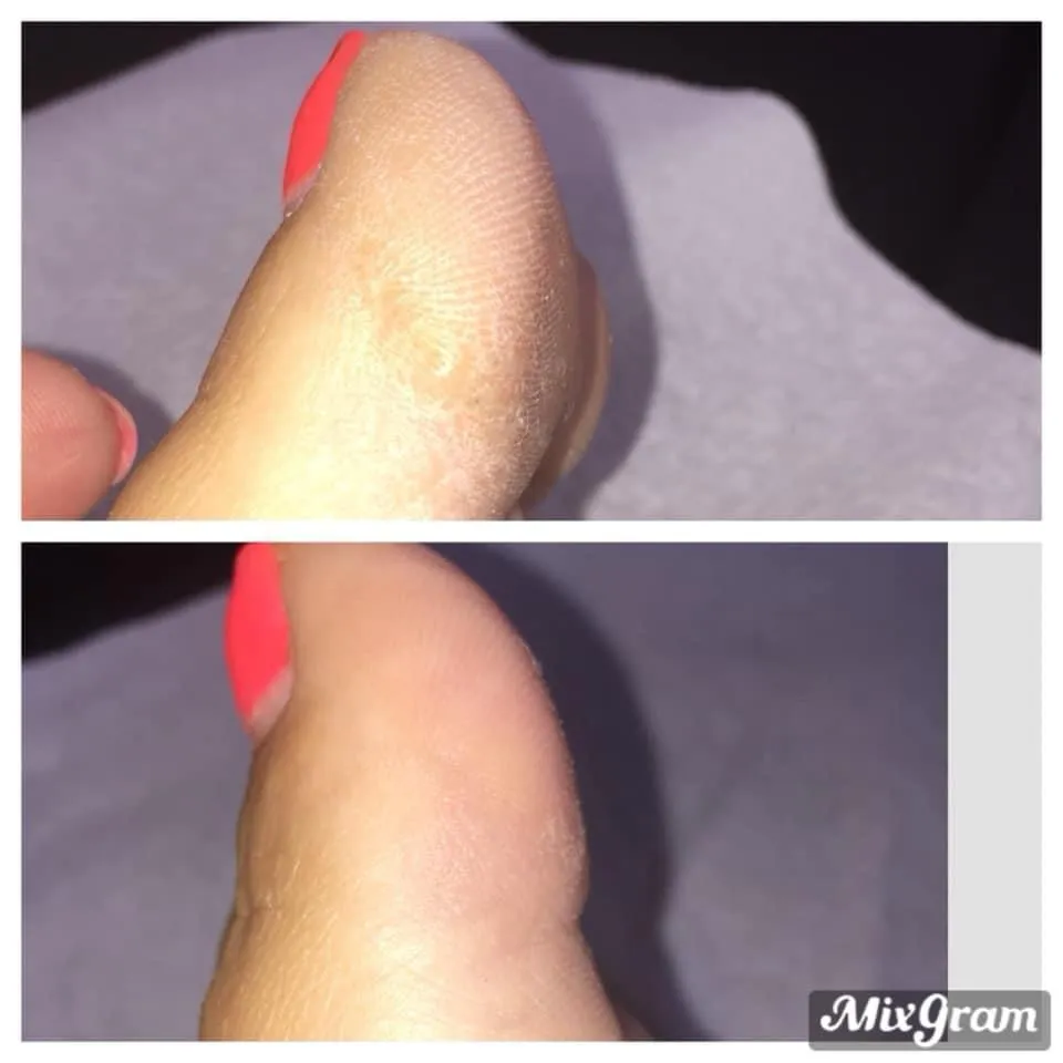 Avant après soin beauté des pieds callosités talon Antibes