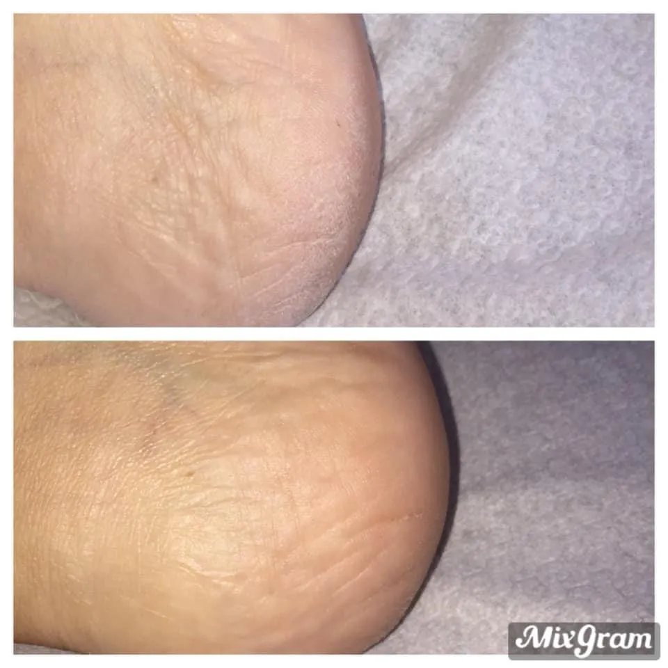 Avant après soin beauté des pieds talon lisse Antibes