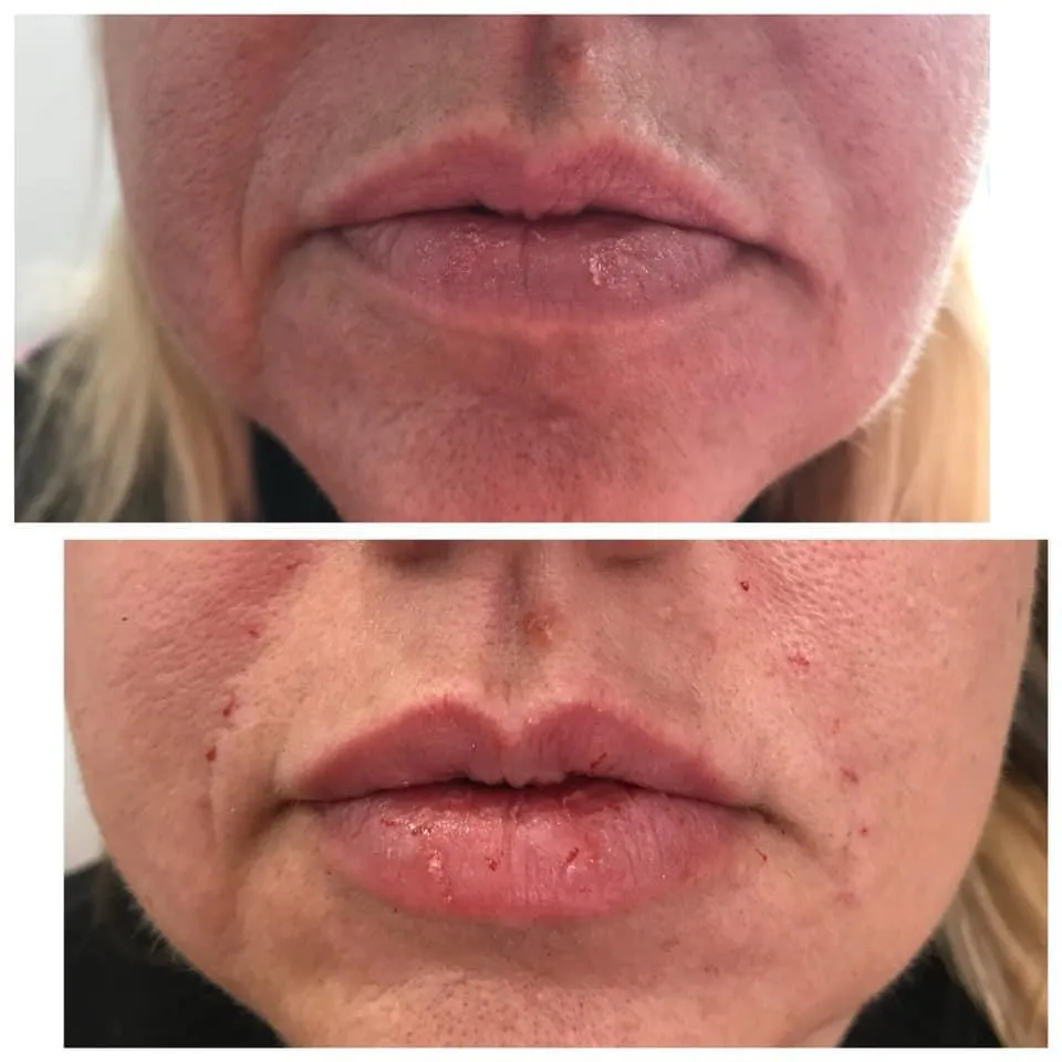 Avant après candy lips maquillage permanent lèvres Antibes