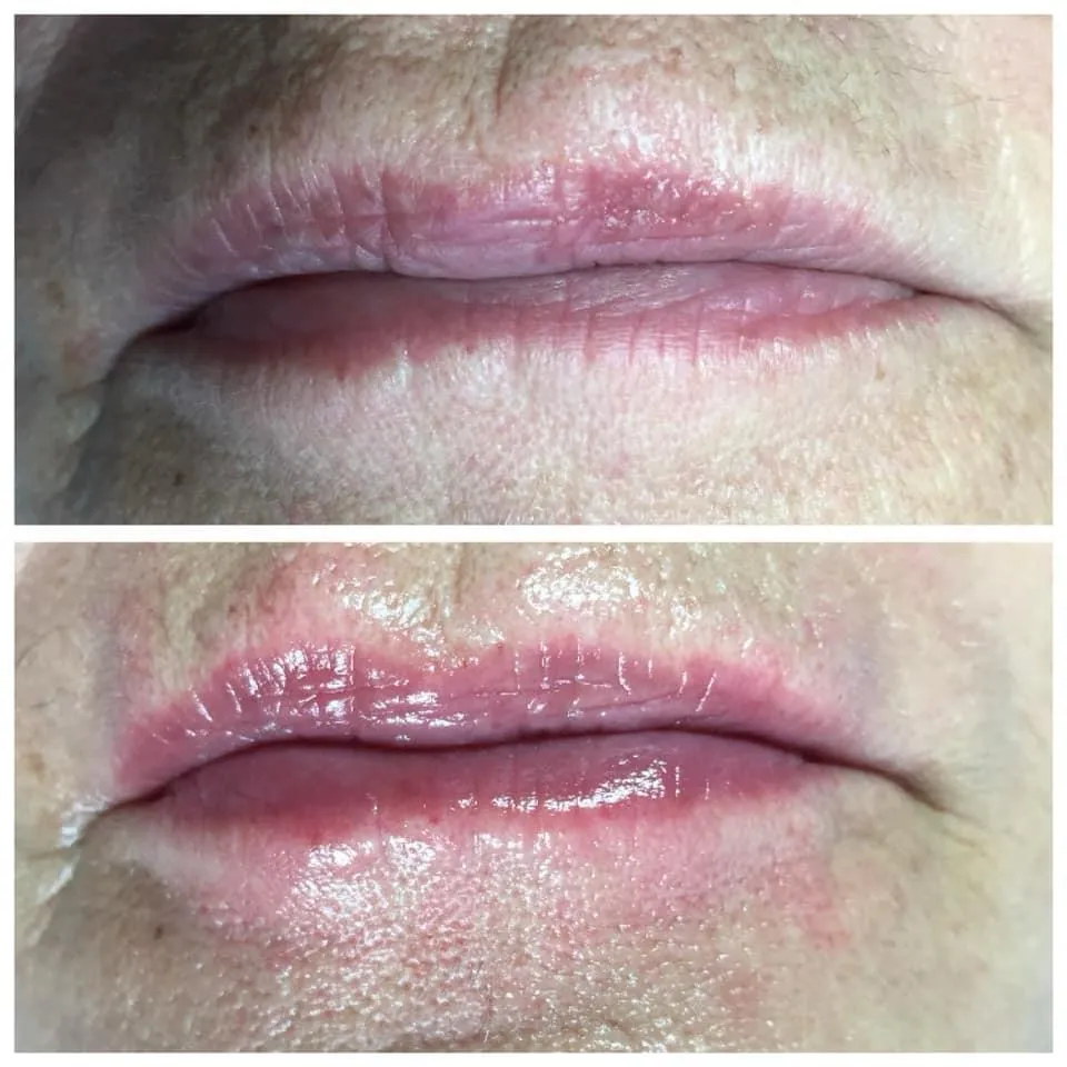 Avant après candy lips effet naturel Antibes