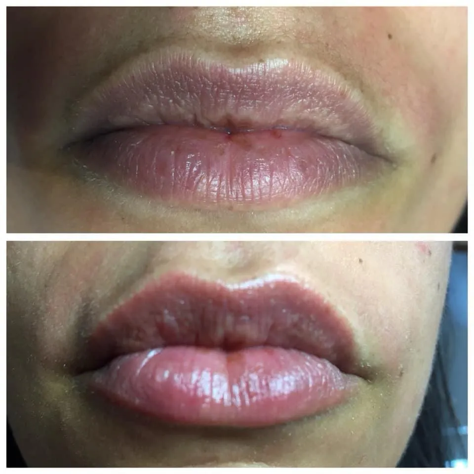 Avant après repigmentation lèvres candy lips Antibes