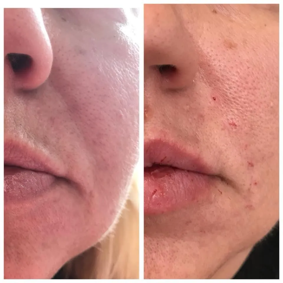 Avant après candy lips contour couleur lèvres Antibes